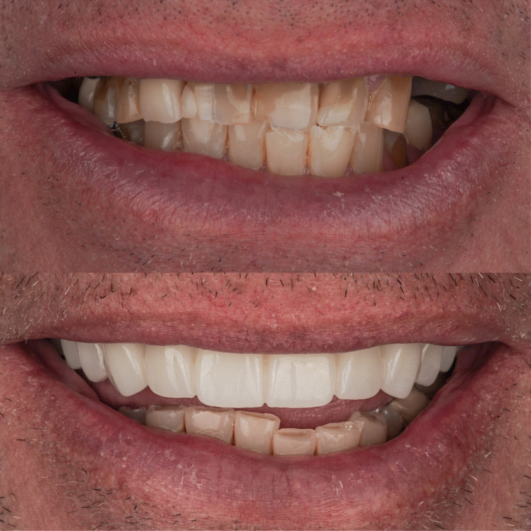 Before and after upper arch FP1 implant-supported restoration